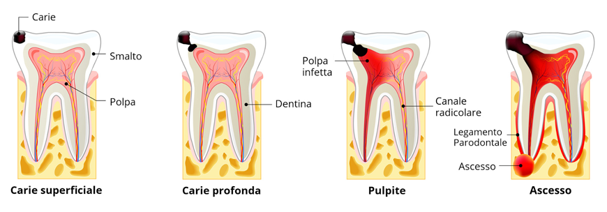 le-fasi-di-sviluppo-carie-870x304
